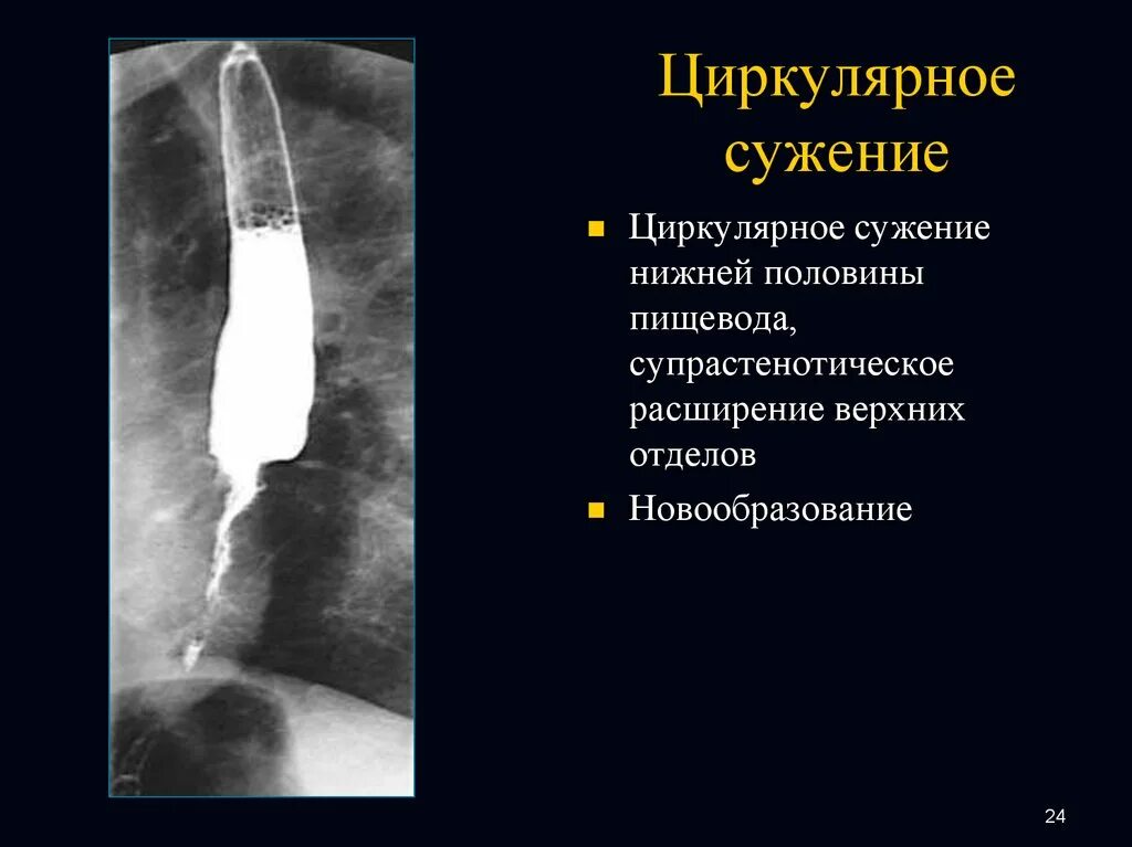 Циркулярное сужение пищевода рентген. Супрастенотическое расширение пищевода. Циркулярная стриктура пищевода. Нижнее расширение пищевода