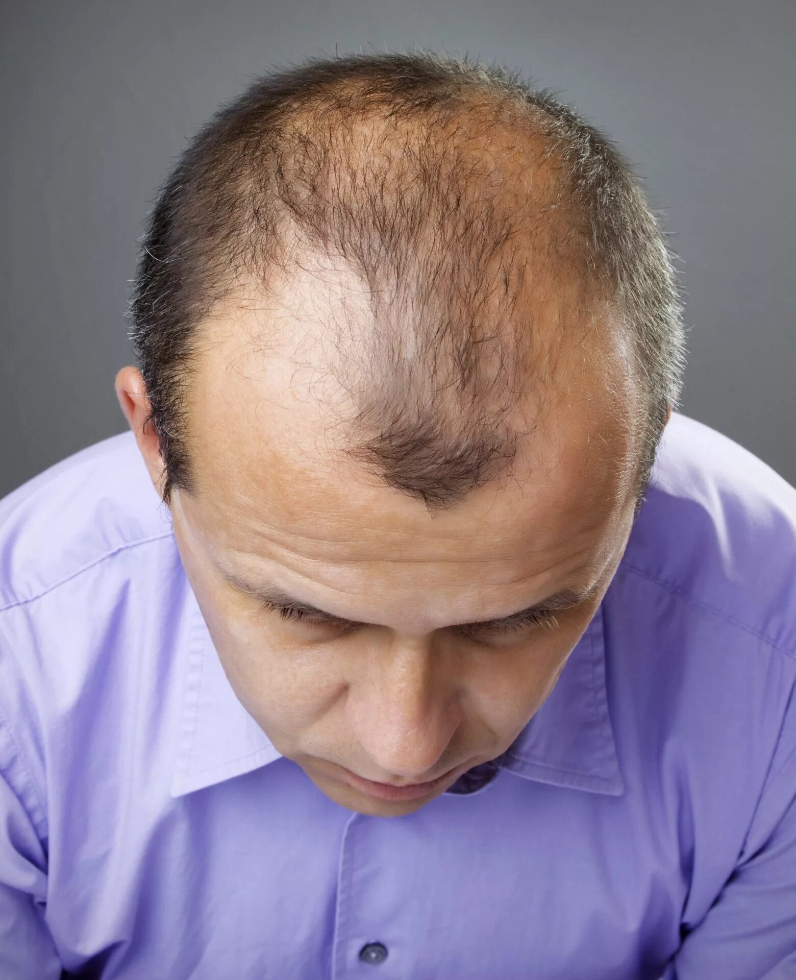 Экозависимая алопеция. Залысины на голове у мужчин. Хайр лосс. Залысины на голове. Что делать если начинаешь лысеть.