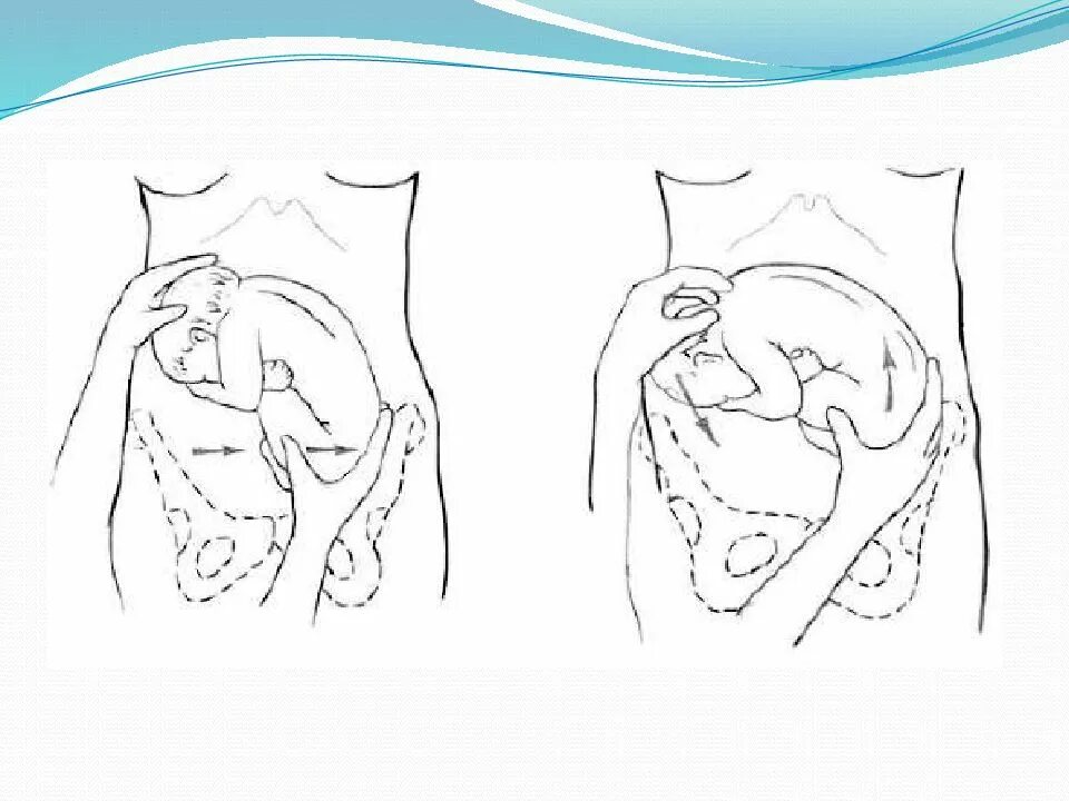 Положение плода акушерское. Ягодичное предлежание плода на 38 неделе беременности. Ягодичное предлежание плода на 34 недели беременности. Тазовое предлежание плода на 36 неделе беременности. Наружный поворот плода на головку при тазовом предлежании.
