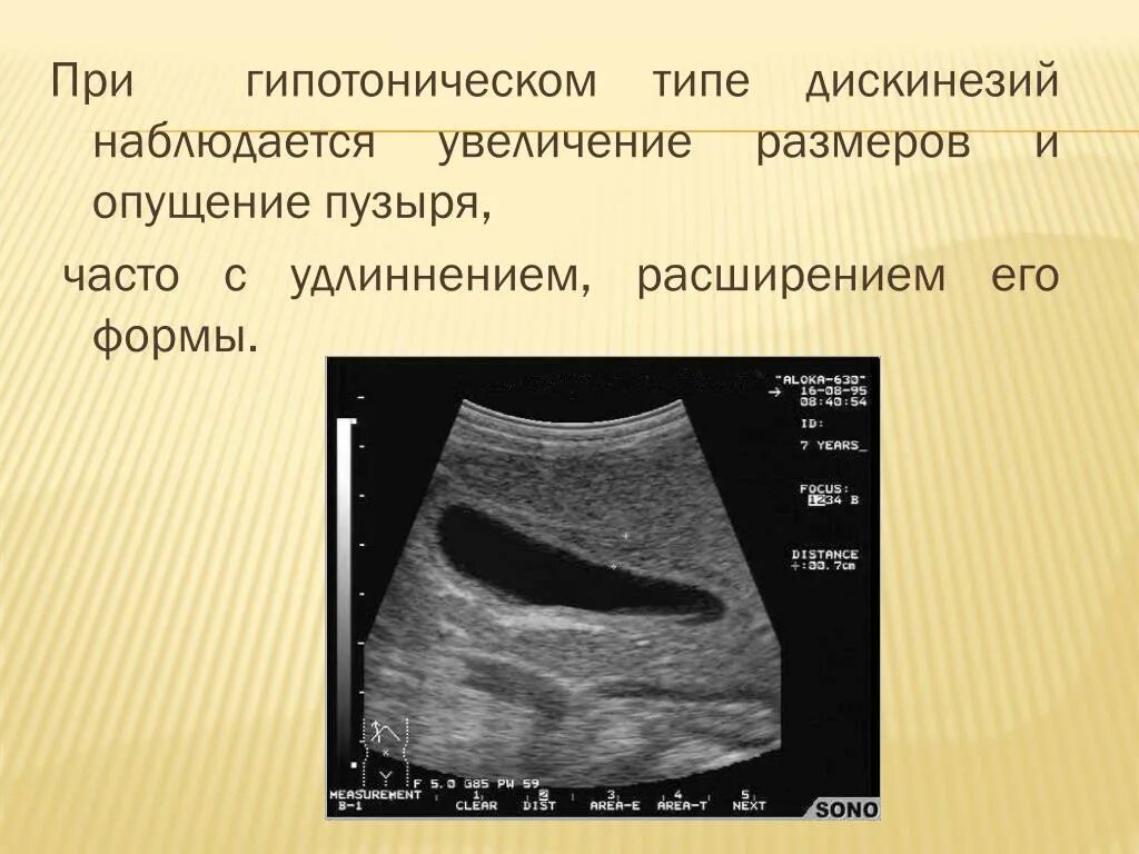 Дискинезия желчного пузыря на УЗИ. Дискинезия желчного на УЗИ. Признаки джвп на УЗИ что это. УЗИ признаки дискинезии. Узи сократимости желчного пузыря