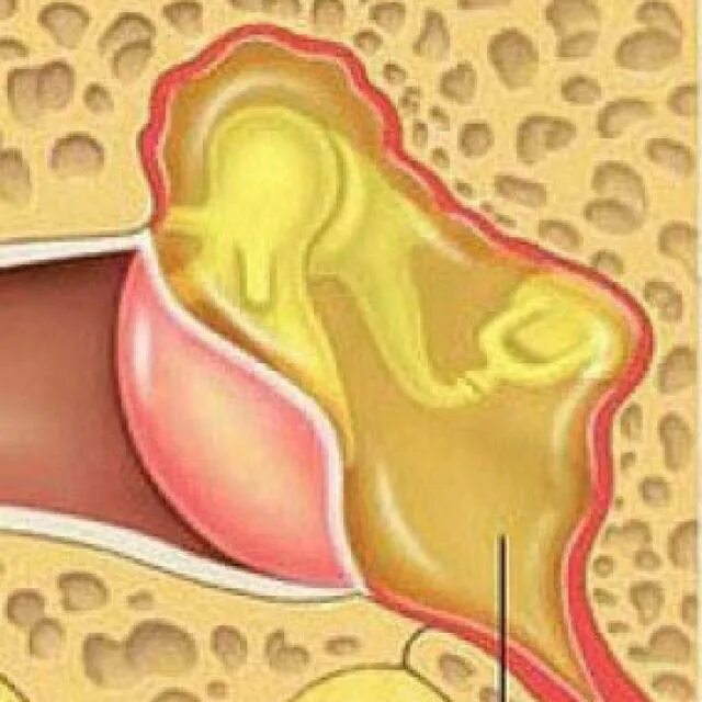 Почему воспаление среднего уха. Острый наружный средний отит. Катаральный средний отит.