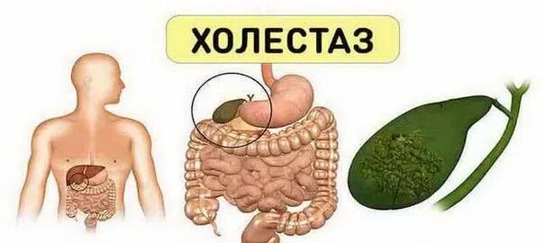 Застой желчного пузыря лечение у взрослых. Внутрипеченочный застой желчи.