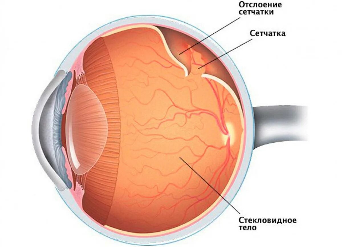 Сетчатая оболочка глазного. Отслоение сетчатки на глазу на глазах. Регматогенная отслойка сетчатки. Отслойка сетчатки ретинальный разрыв.