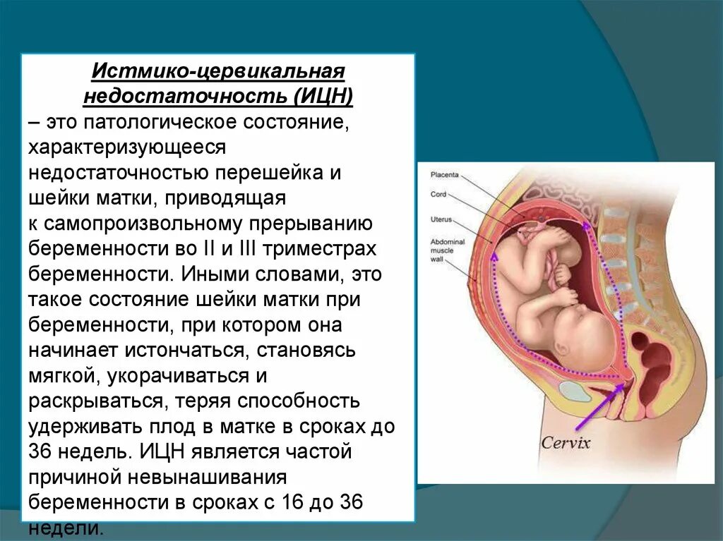 Классификация ИЦН. Истмико-цервикальная недостаточность. Истмикосервикальная недостаточность. Иствикоцервикальрая недостаточность. Самопроизвольные роды до 34 недель