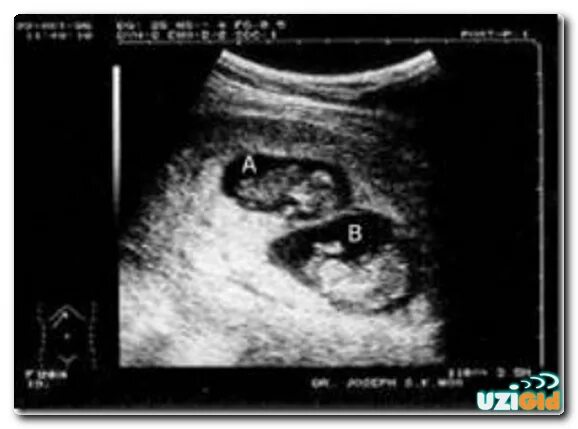 Двойняшки на УЗИ 12 недель беременности. УЗИ 12 недель беременности двойня. УЗИ 19 недель беременности двойня. УЗИ 13 недель беременности двойня.