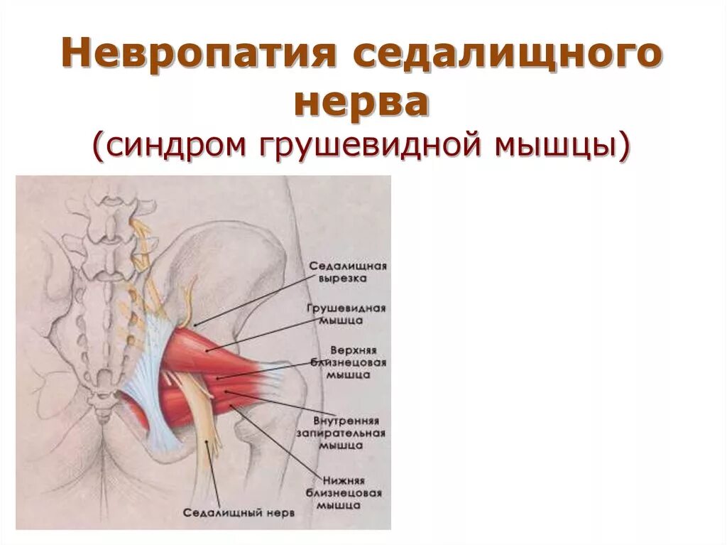 Внутренняя запирательная мышца и грушевидная мышца. Синдром мышевидной мышцы. Синдром грушевидной мышцы. Грушевидная мышца и седалищный нерв.