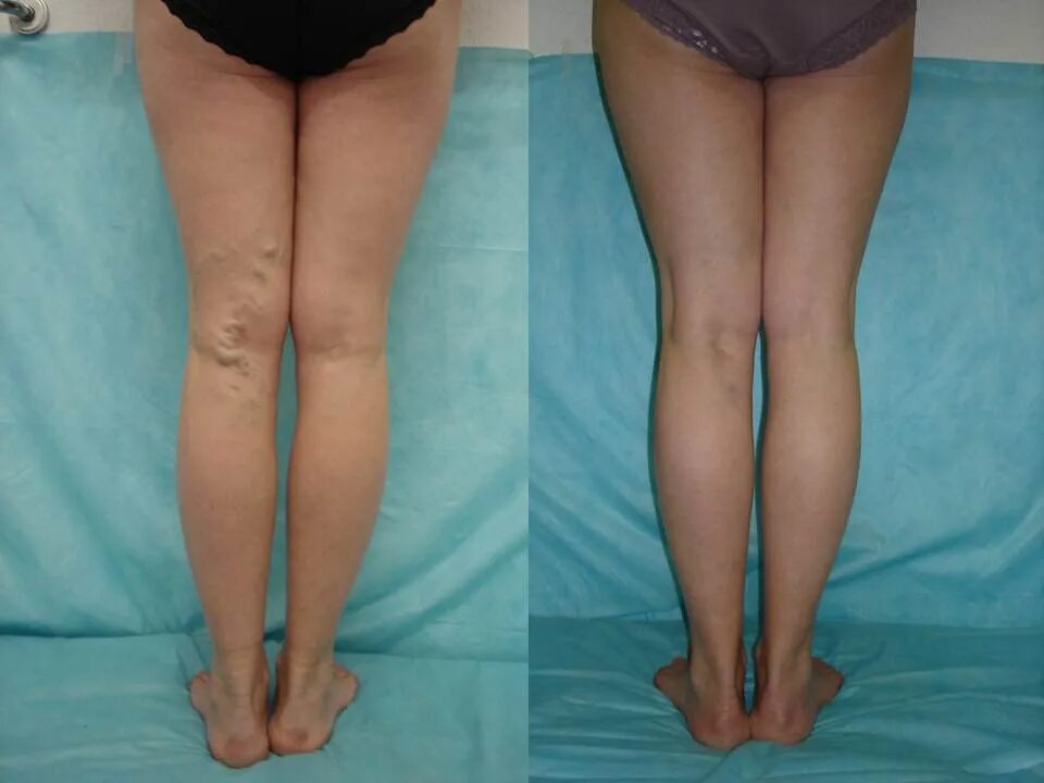 Липосакция икроножных мышц. Варикозное расширение вен голени. Удалили ногу отзыв. Флеботромбоз голени клиника. Эндовенозная лазерная коагуляция варикозных вен.