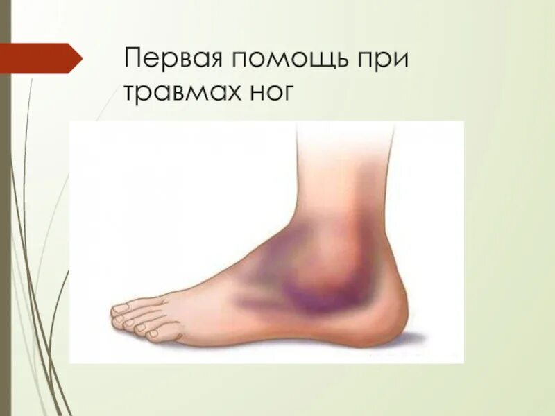 Растяжение голеностопного сустава карта. Закрытый перелом голени карта вызова. карта вызова смп перелом лодыжки. ушиб голеностопного сустава карта вызова смп. перелом стопы карта вызова.