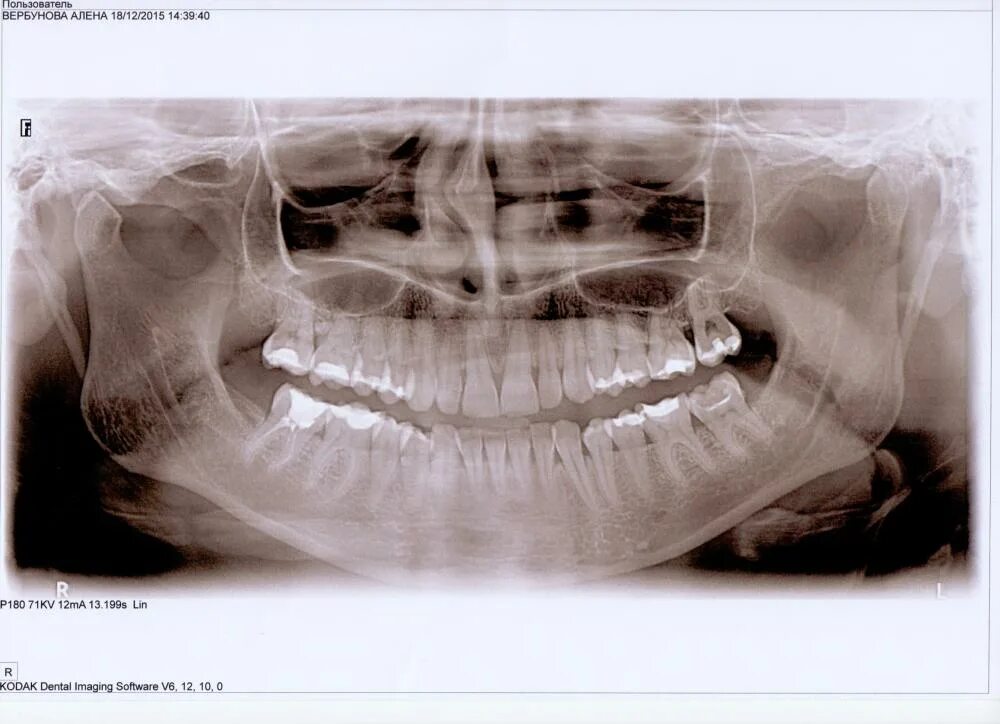 Снимок зубов видное. Саркома нижней челюсти рентген.
