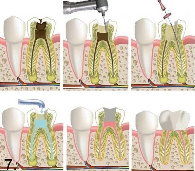 Трехканальный пульпит. Пульпит 2 канального зуба. Методы обезболивания пульпы. Пульпит обезболивающие. Гипертрофический пульпит.