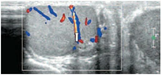 Одно яичко стало. УЗИ мошонки варикоцеле. Варикоцеле УЗИ методика. УЗИ органов мошонки с ЦДК.