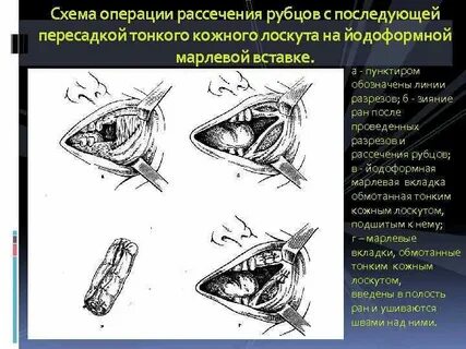 Зияние