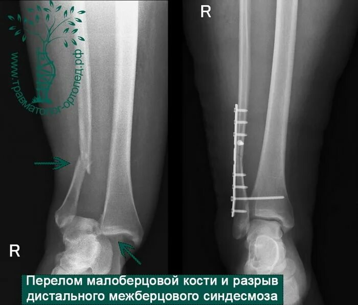 Перелом малоберцовой кости рентген. Перелом малой берцовой кости снимок. Перелом большеберцовой кости рентген. Перелом метаэпифиза малоберцовой кости. Операция малоберцовой кости