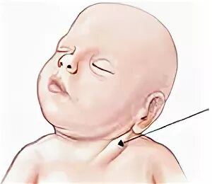 Мышечная кривошея: причины, симптомы и лечение в статье ортопеда Виноградова Е. 