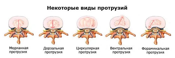 Дорзальная протрузия диска что это такое. Дорзальная протрузия с3-с4. дорзальная диффузная протрузия межпозвонкового диска с3-с4. медианная дорзальная протрузия l23. классификация протрузий межпозвонковых дисков.