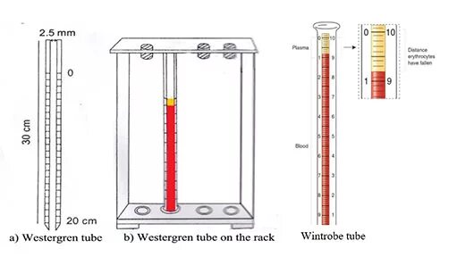 Прибор Панченкова СОЭ. Метод Вестергрена СОЭ. СОЭ капилляр Панченкова. Постановка СОЭ методом Панченкова. Анализ крови соэ по панченкову