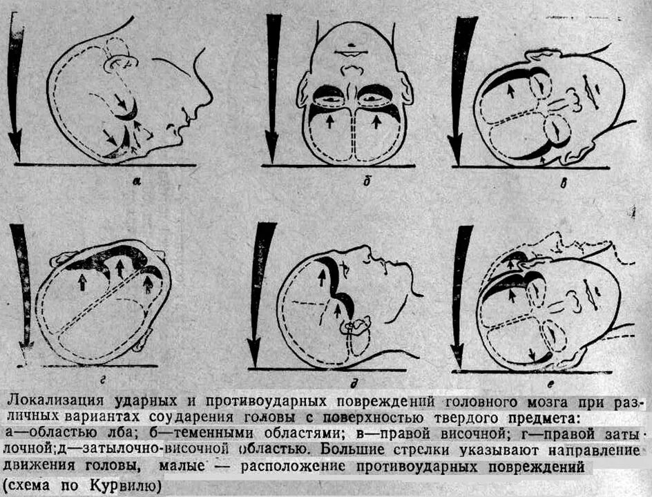 Ушиб головного мозга механизм повреждения. Повреждения мозга при травме головы. Ушиб головного мозга и сотрясение головного.