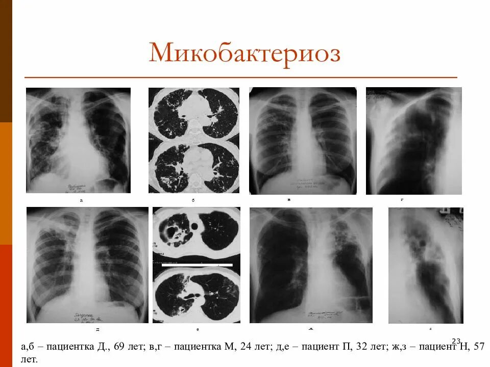 Микобактериоз и туберкулез. Нетуберкулезный микобактериоз легких кт. Нетуберкулезный микобактериоз