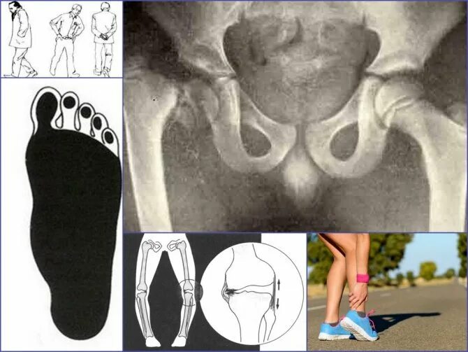Варусная деформация коленных суставов. Вальгус тазобедренного сустава. Вальгусная и варусная деформация коленных суставов на рентгене. Варусная деформация тазобедренного сустава.