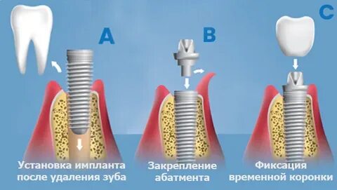 Можно ли после удаления поставить