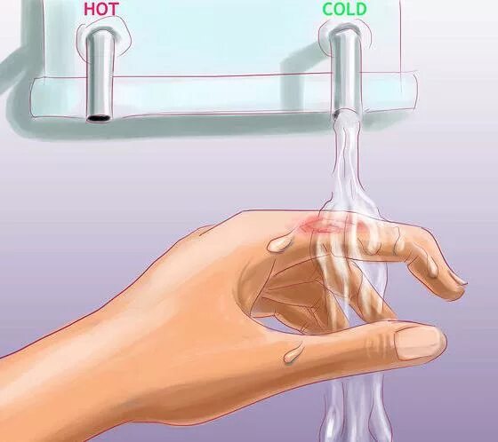 Ожог горячей водой в домашних условиях. Рука с ожогом под струей воды.