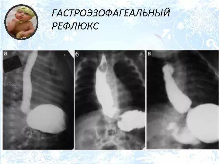 Рефлюкс у подростков. Гастроэзофагеальный рефлюкс рентген. рентгенологическое исследование пищевода при гэрб.