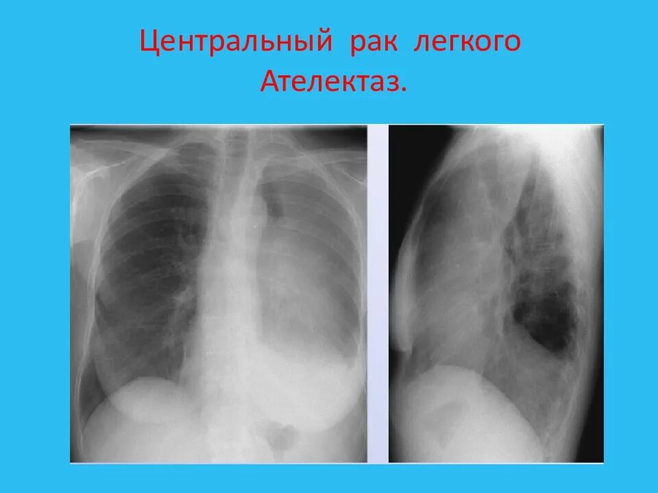 Уентральныйрак легкого. Центральный ателектаз легких. Центральная опухоль легкого. Центральный рак правого