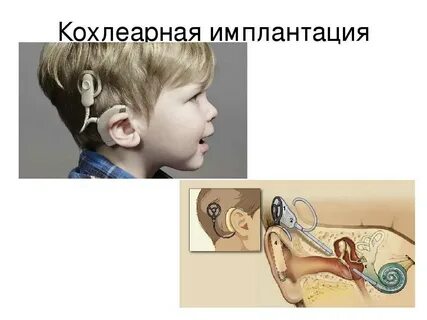 Кохлеарная имплантация это