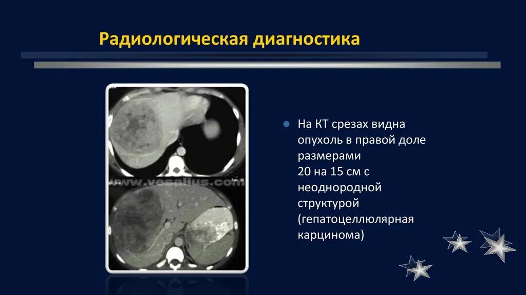 Неоднородность опухоли. Радиологическая диагностика. Новообразование с неоднородной структурой. Диагностический срез.