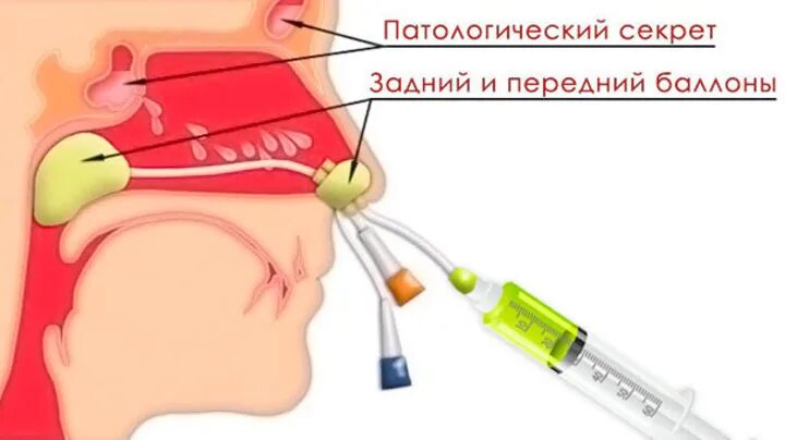 Как лечить гайморит у взрослых прокол