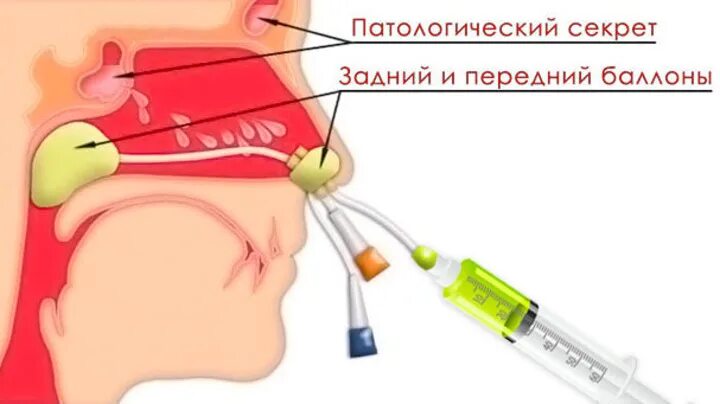 После прокола гайморовой. ЯМИК-3 катетер. Назальный катетер ЯМИК-3. Катетер для промывки гайморовых пазух.