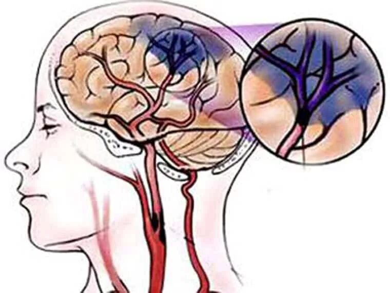 Ишемический инсульт головного мозга. Транзиторная ишемическая атака и инсульт. Микроинсульт головного мозга симптомы. Расширенные сосуды в голове. Головной микроинсульт