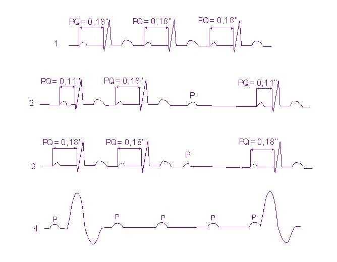 Са блокада типы. Синоатриальная блокада Мобитц 1. Синоатриальная блокада 2 степени типа Мобитц 1. Са блокада 2 степени Мобитц 1 на ЭКГ. Синоатриальная блокада 2 степени 1 типа.