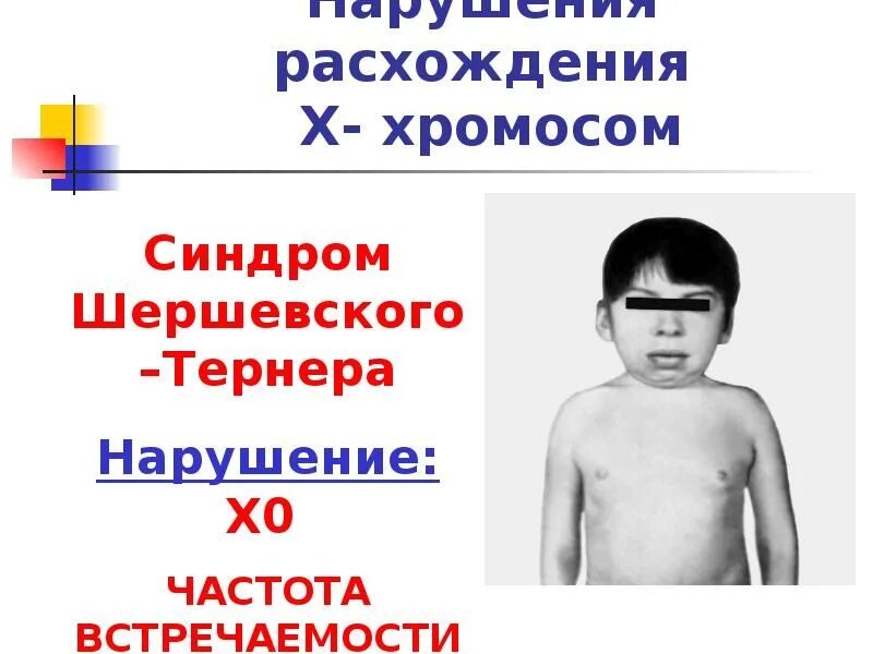 Нарушение расхождения хромосом. Синдром шершевского тёрнера. 40 хромосом у человека.