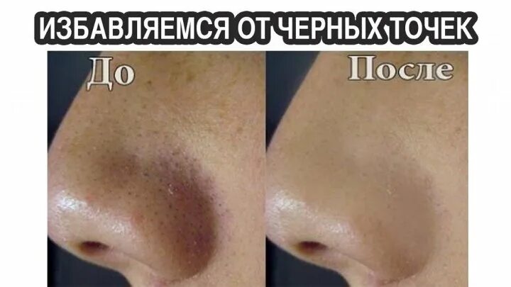 Что находится внутри черных точек Szybkie sposoby na pryszcze Акне, Лечение акне, Косметология
