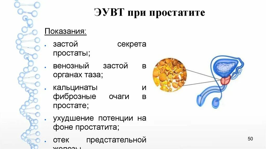 Как убрать простату. Застои в предстательной. Застой секрета в предстательной железе.