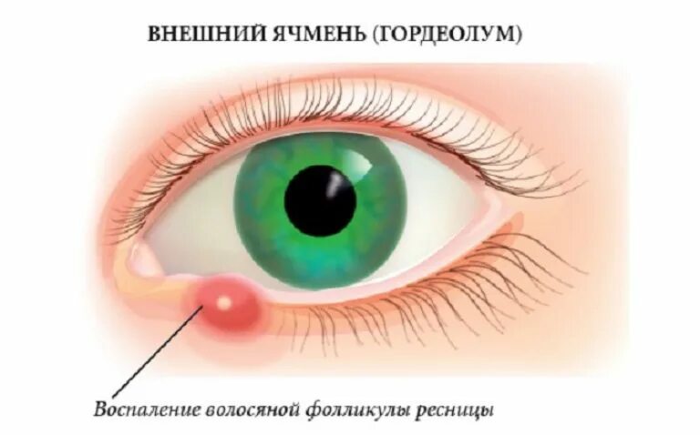 Можно ли гулять с коньюктивитом. Воспаление мейбомиевой железы глаза.