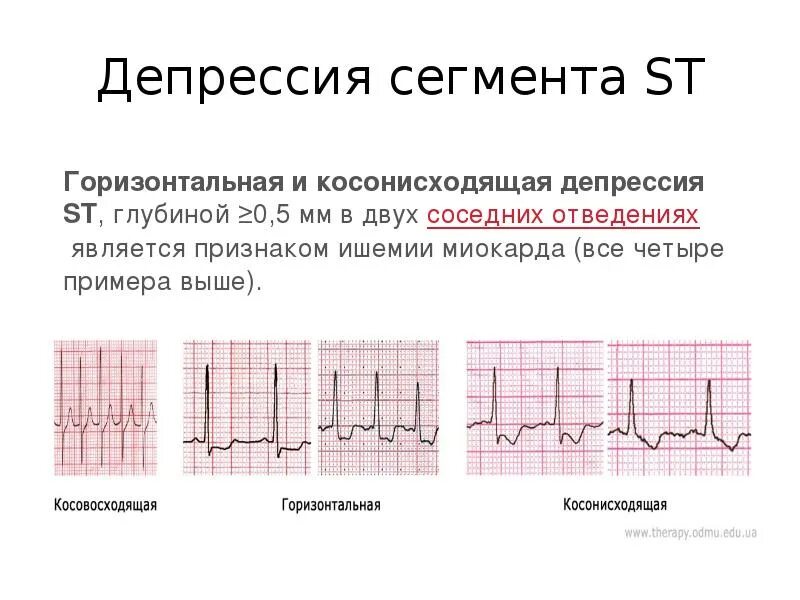 Косонисходящая депрессия сегмента. Депрессия st в 1 и avl. подъем сегмента st на экг v3. косонисходящая депрессия сегмента st в v1. депрессия сегмента st подъем st v1-3.