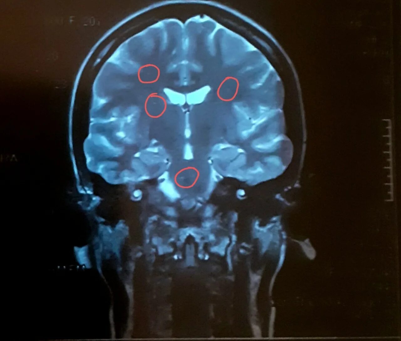 Опухоль головного мозга снимок мрт. Опухоль головного мозга на мрт с контрастом. Мрт головы с контрастом. Снимок мрт головного мозга с аневризмой.