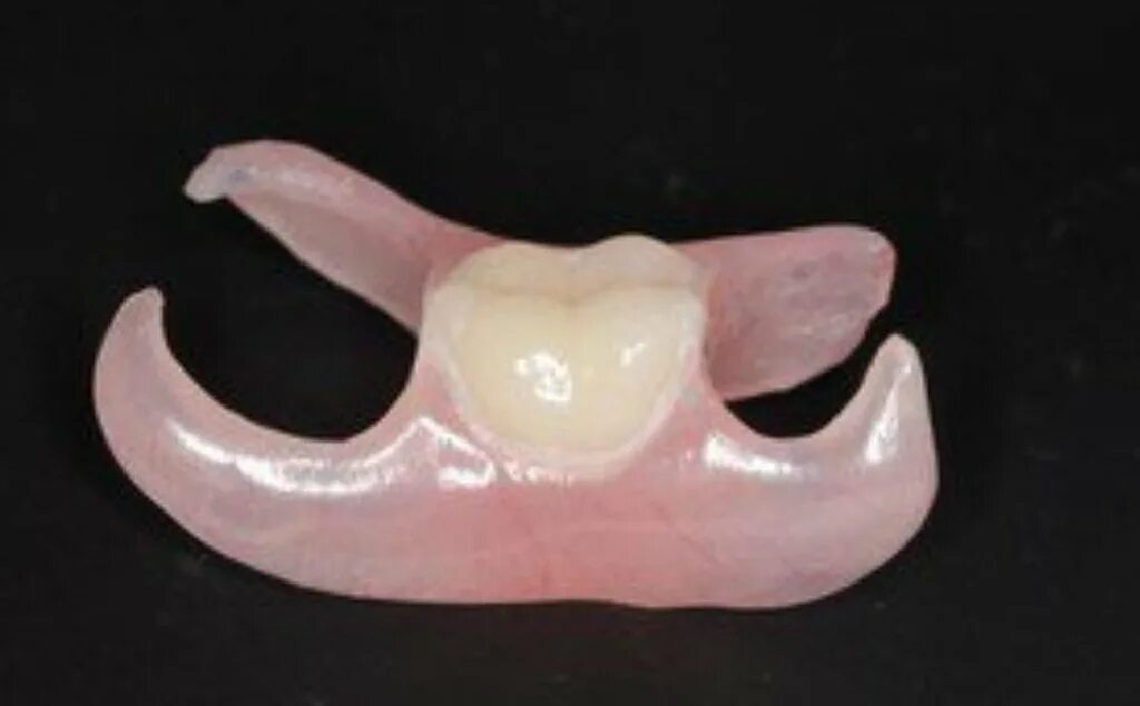 Съемный протез зуба бабочка. Съемный микропротез «бабочка». Зубной микропротез бабочка. Иммедиат протез бабочка 1 зуб. Иммедиат-протез (временный протез "бабочка".