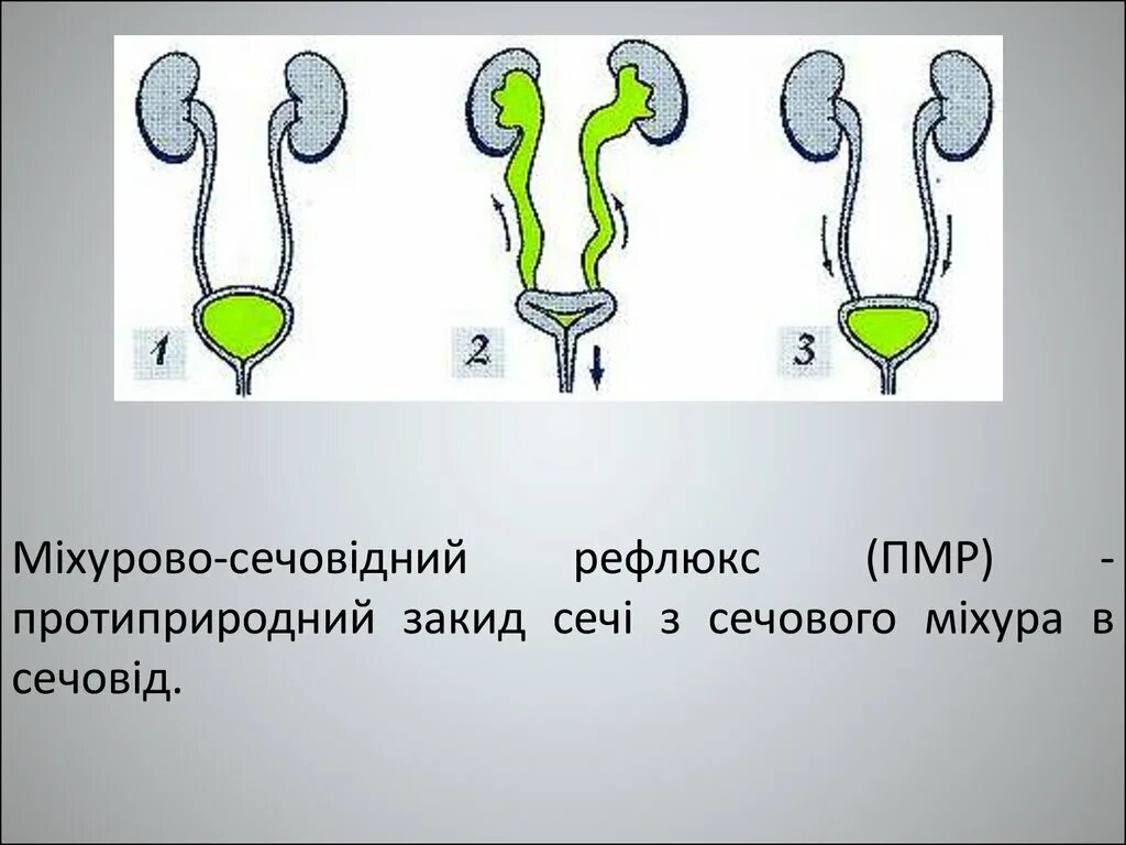 Рефлюкс мочи