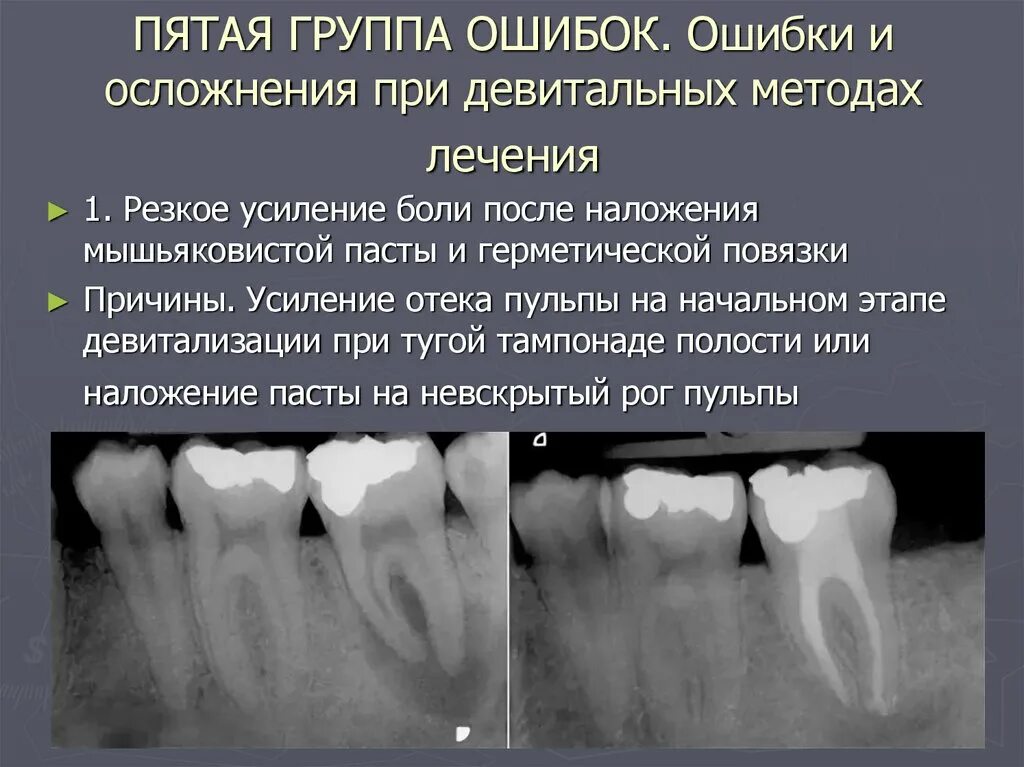 Осложнения лечения кариеса. Многокорневой пульпит. Периодонтит зуба рентген. Ошибки и осложнения пульпита.