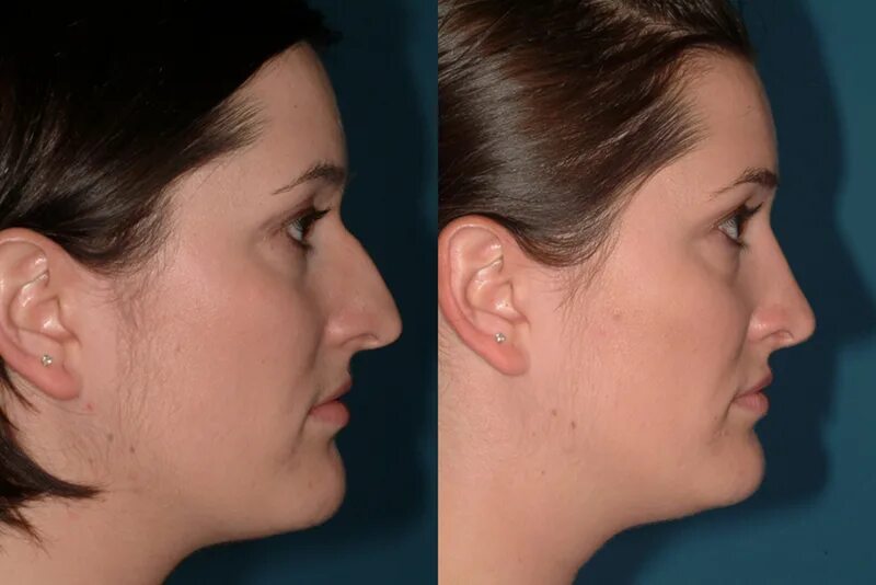 Упражнения для уменьшения носа до и после. Форма мочки носа. Упражнения для изменения формы носа.