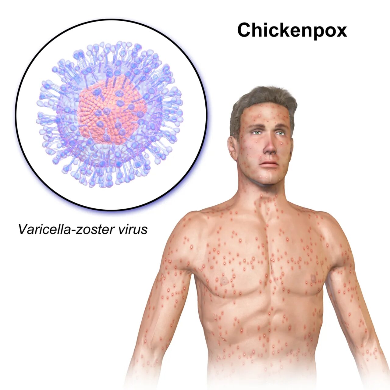 Организм после вируса. Вирус герпеса 3 типа varicella-zoster. Опоясывающий герпес и ветрянка.