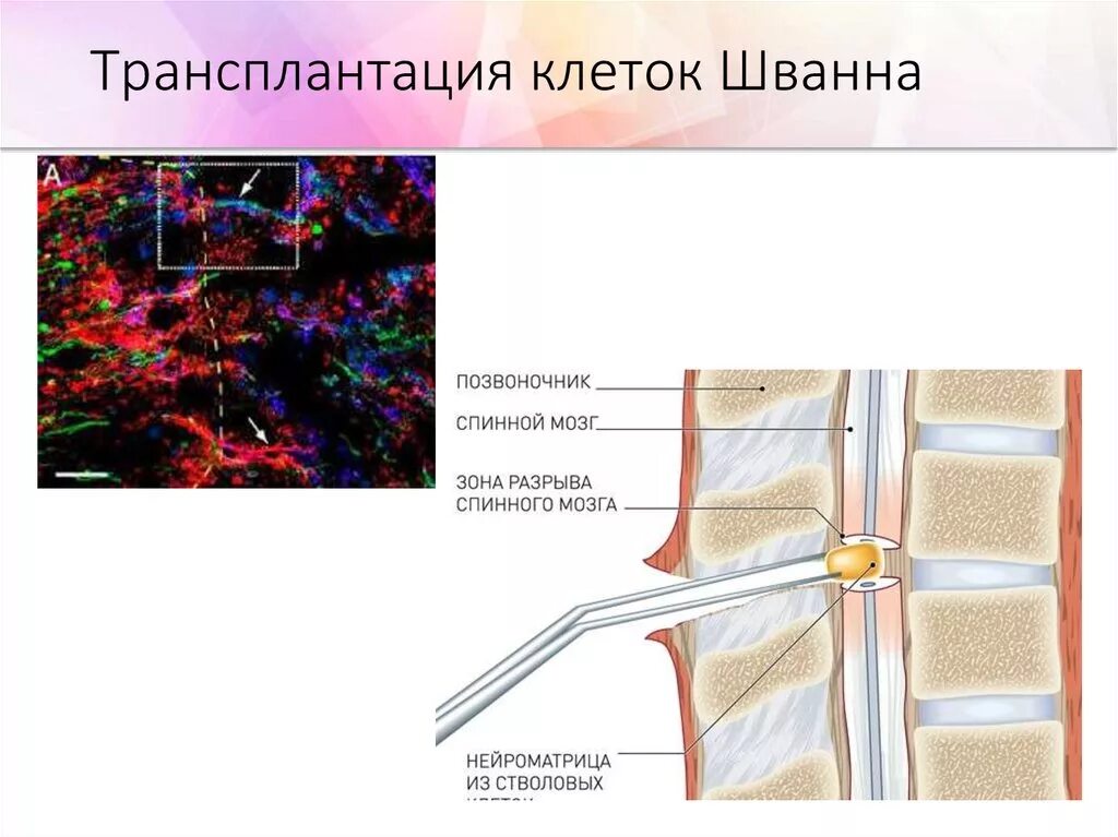 Трансплантация спинного мозга. Трансплантация шванновских клеток. Клетки спинного мозга. Стволовые клетки спинного мозга.