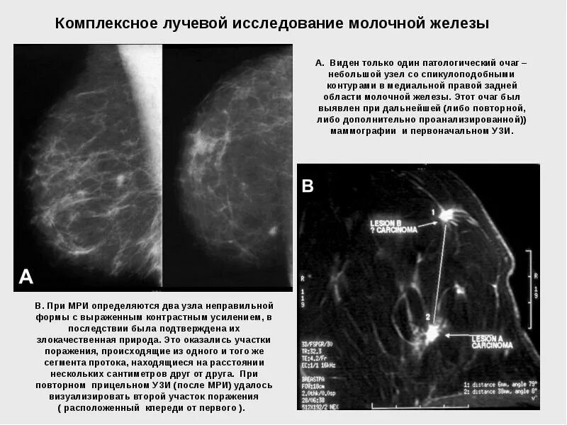 Жизнь при раке молочной железы. Узи диагностика заболеваний молочных желез. методы лучевого исследования молочных желез. методика исследования молочных желез. рентгенодиагностика заболеваний молочной железы.