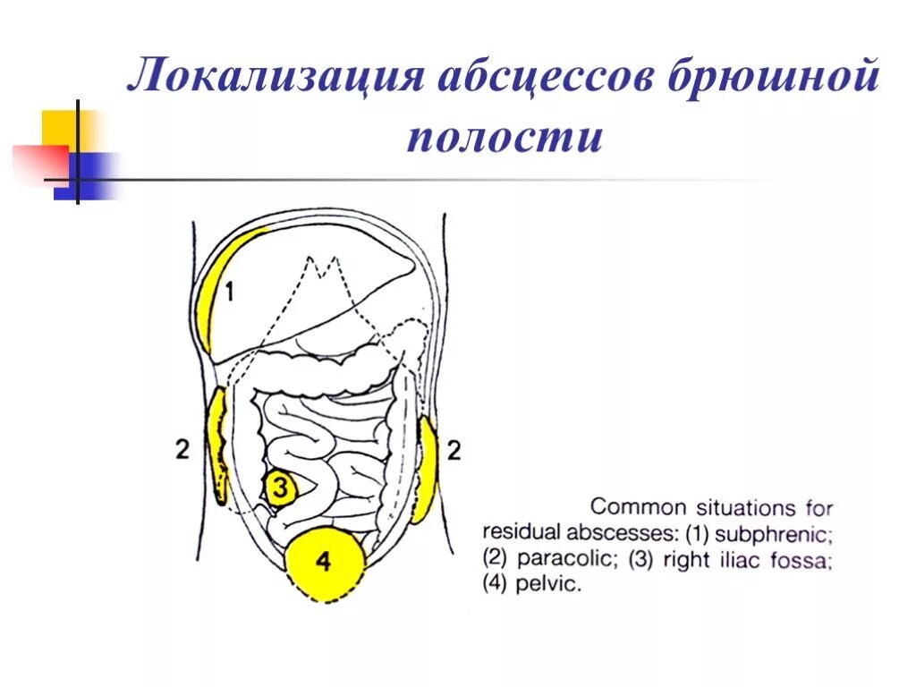 Типичные места локализации абсцессов в брюшной полости. Абсцессы брюшной полости клиника. Типичные места образования абсцессов брюшной полости. Локализация гнойников в брюшной полости. Наличие гноя в брюшной полости