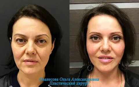 Фейслифтинг для лица массажем