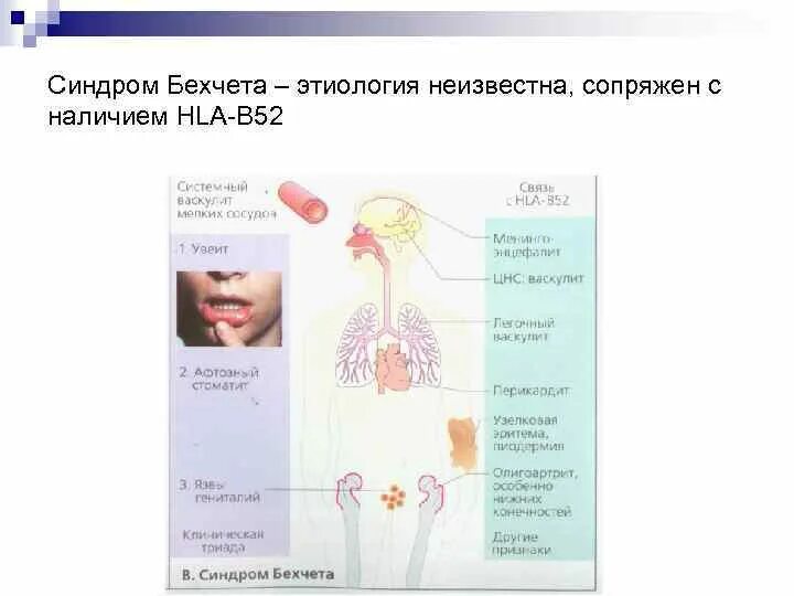 Болезнь бехчета симптомы. Болезнь бехчета симптомы