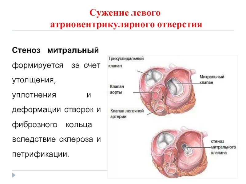 Митральный аортальный стеноз. Клапан сердца порок двухстворчатый аортальный клапан. Митральный клапан схема. Фиброзное кольцо митрального клапана норма. Фиброзное кольцо митрального клапана.